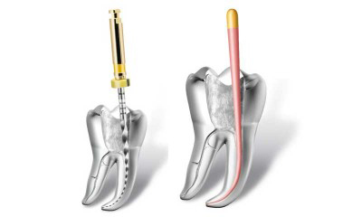 Root canal illustration