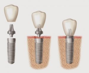 dental implant illustration image