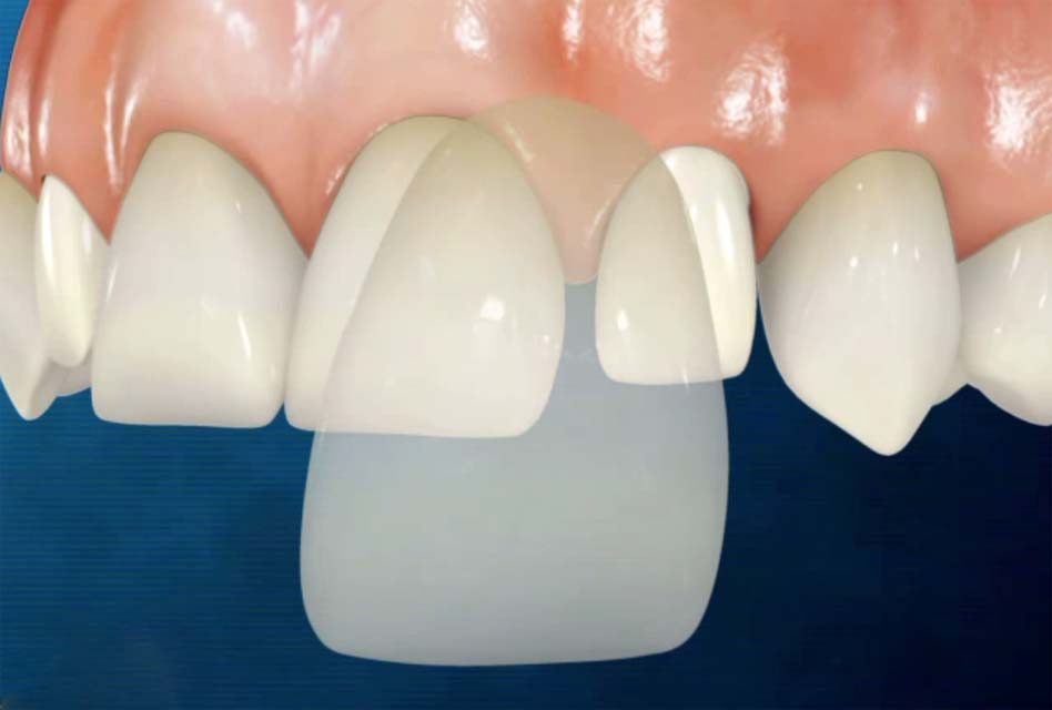 dental veneer image