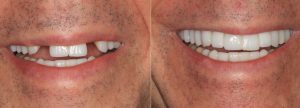 dental implants before and after image