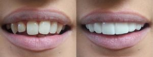 veneers before and after image