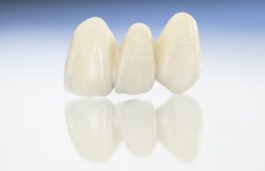 partial dentures image